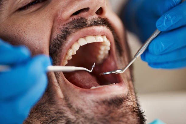 Best Emergency Dentist for Lost Fillings or Crowns in Concord, AL